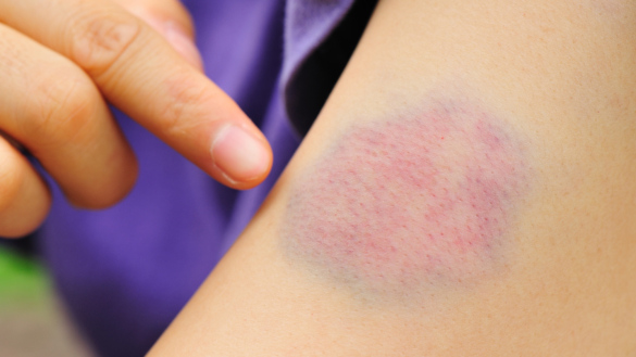 Verisyöpä (leukemia)